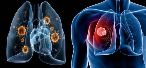 Những dấu hiệu ung thư phổi không tế bào nhỏ các giai đoạn 